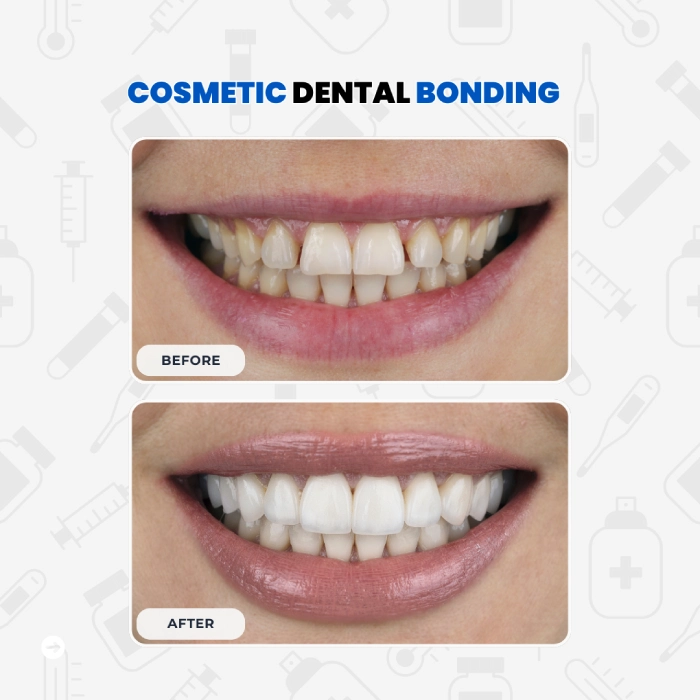 Cosmetic Dental Bonding